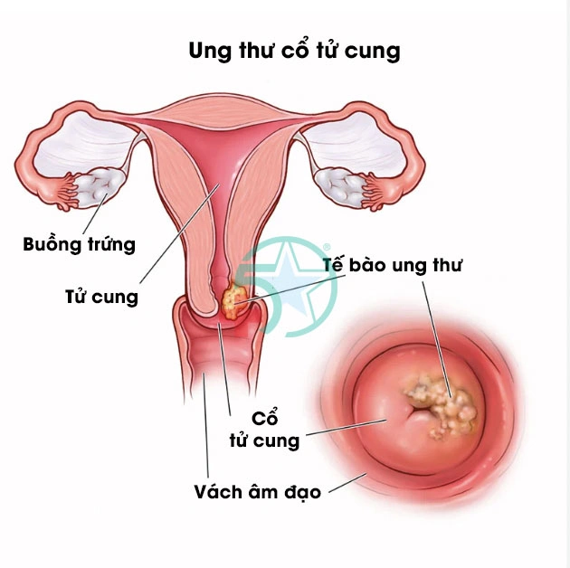 Siêu âm sàng lọc ung thư Giáp - Vú - Cổ tử cung