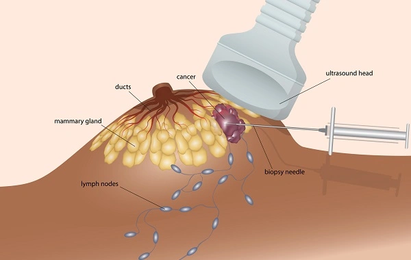 Siêu âm sàng lọc ung thư Giáp - Vú - Cổ tử cung