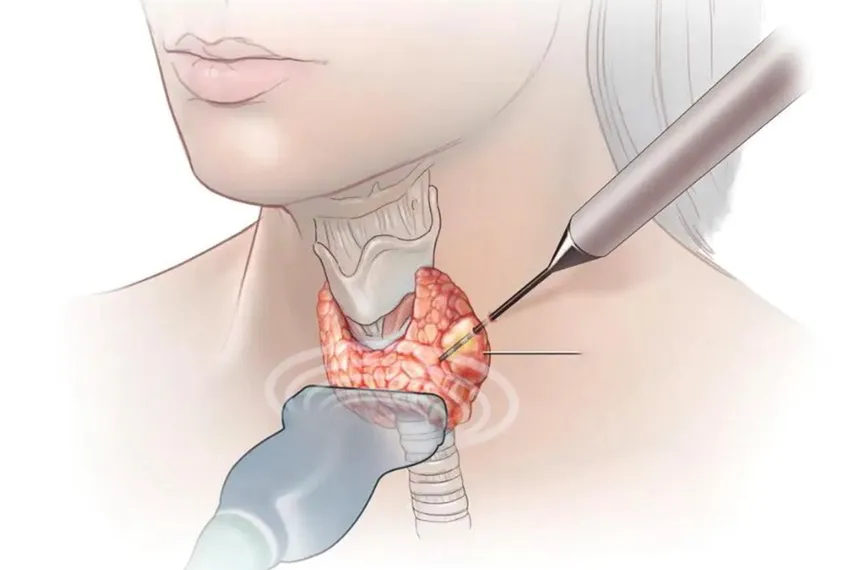 Tư vấn đốt sóng cao tần điều trị u tuyến giáp