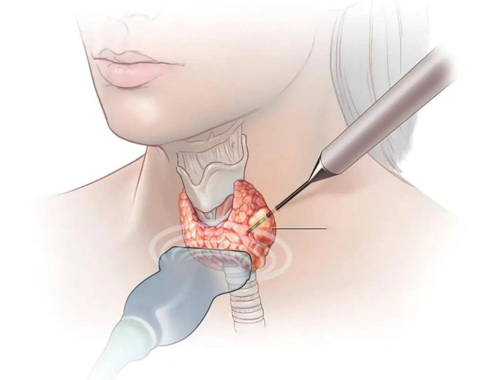 Tư vấn đốt sóng cao tần điều trị u tuyến giáp
